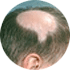 Alopecia areata