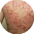 Psoriasis listing